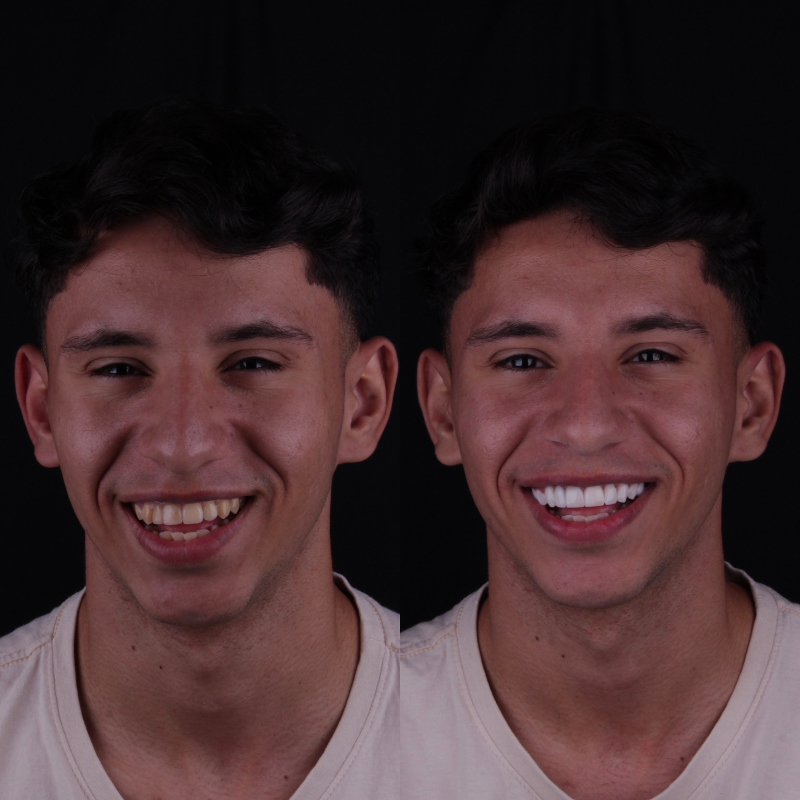 lentes de resina e porcelana