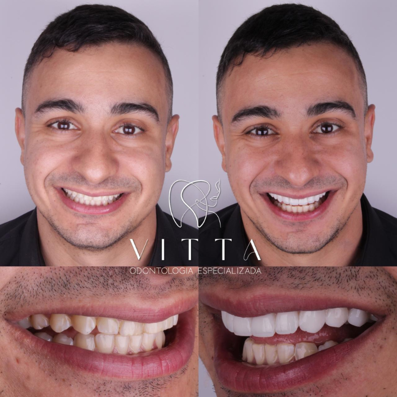 lentes de resina ou porcelana